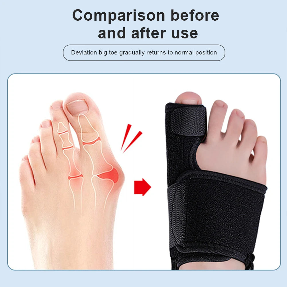 Hallux Valgus Bunion Corrector — Adjustable Toe Straightener & Orthopedic Brace